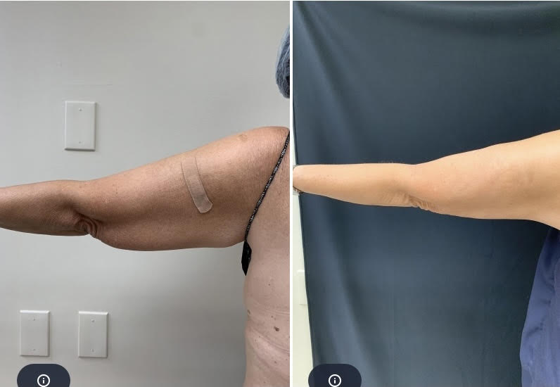 Liposuction AND J Plasma ( Renuvion) Dr Varano- Washington DC Liposuction AND J Plasma ( Renuvion) Dr Varano- Washington DC